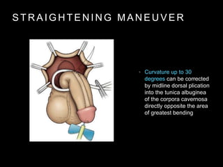 S T R A I G H T E N I N G M A N E U V E R
• Curvature up to 30
degrees can be corrected
by midline dorsal plication
into the tunica albuginea
of the corpora cavernosa
directly opposite the area
of greatest bending
 