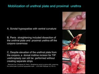 A, Scrotal hypospadias with ventral curvature
B, Penis straightening included dissection of
the urethral plate and proximal urethra off the
corpora cavernosa
C, Despite elevation of the urethral plate from
the corpora, a dorsal midline incision for TIP
urethroplasty can still be performed without
creating separate strips
(Reprinted from Snodgrass W, Prieto J. Straightening ventral curvature while preserving
the urethral plate in proximal hypospadias repair. J Urol 2009;182[Suppl. 4]:1720–5.)
Mobilization of urethral plate and proximal urethra
 