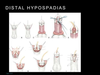 D I S T A L H Y P O S P A D I A S
 