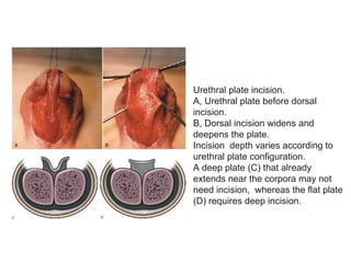 Urethral plate incision.
A, Urethral plate before dorsal
incision.
B, Dorsal incision widens and
deepens the plate.
Incision depth varies according to
urethral plate configuration.
A deep plate (C) that already
extends near the corpora may not
need incision, whereas the flat plate
(D) requires deep incision.
 