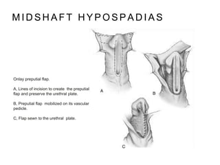 M I D S H A F T H Y P O S P A D I A S
Onlay preputial flap.
A, Lines of incision to create the preputial
flap and preserve the urethral plate.
B, Preputial flap mobilized on its vascular
pedicle.
C, Flap sewn to the urethral plate.
 