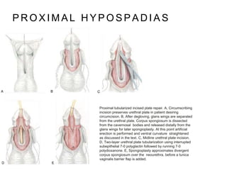 P R O X I M A L H Y P O S P A D I A S
Proximal tubularized incised plate repair. A, Circumscribing
incision preserves urethral plate in patient desiring
circumcision. B, After degloving, glans wings are separated
from the urethral plate. Corpus spongiosum is dissected
from the cavernosal bodies and released distally from the
glans wings for later spongioplasty. At this point artificial
erection is performed and ventral curvature straightened
as discussed in the text. C, Midline urethral plate incision.
D, Two-layer urethral plate tubularization using interrupted
subepithelial 7-0 polyglactin followed by running 7-0
polydioxanone. E, Spongioplasty approximates divergent
corpus spongiosum over the neourethra, before a tunica
vaginalis barrier flap is added.
 