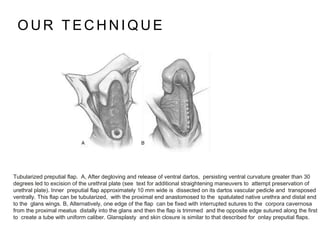 O U R T E C H N I Q U E
Tubularized preputial flap. A, After degloving and release of ventral dartos, persisting ventral curvature greater than 30
degrees led to excision of the urethral plate (see text for additional straightening maneuvers to attempt preservation of
urethral plate). Inner preputial flap approximately 10 mm wide is dissected on its dartos vascular pedicle and transposed
ventrally. This flap can be tubularized, with the proximal end anastomosed to the spatulated native urethra and distal end
to the glans wings. B, Alternatively, one edge of the flap can be fixed with interrupted sutures to the corpora cavernosa
from the proximal meatus distally into the glans and then the flap is trimmed and the opposite edge sutured along the first
to create a tube with uniform caliber. Glansplasty and skin closure is similar to that described for onlay preputial flaps.
 