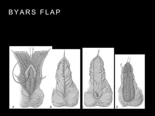 B Y A R S F L A P
 