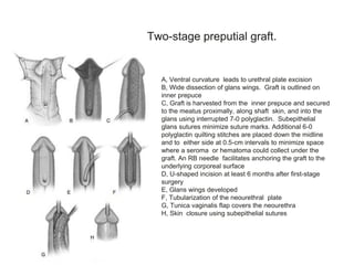 A, Ventral curvature leads to urethral plate excision
B, Wide dissection of glans wings. Graft is outlined on
inner prepuce
C, Graft is harvested from the inner prepuce and secured
to the meatus proximally, along shaft skin, and into the
glans using interrupted 7-0 polyglactin. Subepithelial
glans sutures minimize suture marks. Additional 6-0
polyglactin quilting stitches are placed down the midline
and to either side at 0.5-cm intervals to minimize space
where a seroma or hematoma could collect under the
graft. An RB needle facilitates anchoring the graft to the
underlying corporeal surface
D, U-shaped incision at least 6 months after first-stage
surgery
E, Glans wings developed
F, Tubularization of the neourethral plate
G, Tunica vaginalis flap covers the neourethra
H, Skin closure using subepithelial sutures
Two-stage preputial graft.
 