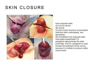 S K I N C L O S U R E
Inner preputial collar.
(A) Line for dorsal
(B) ventral
(C) skin incision,Excision of perimeatal
shaft skin after urethroplasty and
glansplasty
(D) Completed inner preputial collar.
Interrupted subepithelial 7-0
polyglactin approximates the sides
proximally, and 9-0 polyglactin is used
through the epithelium at the corona,
because it is unlikely to produce visible
suture tracks
 