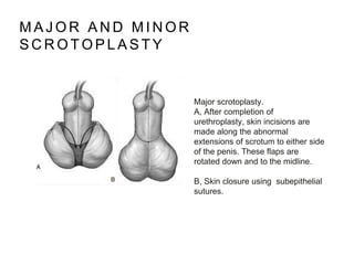 M A J O R A N D M I N O R
S C R O T O P L A S T Y
Major scrotoplasty.
A, After completion of
urethroplasty, skin incisions are
made along the abnormal
extensions of scrotum to either side
of the penis. These flaps are
rotated down and to the midline.
B, Skin closure using subepithelial
sutures.
 