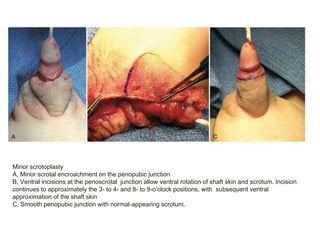 Minor scrotoplasty
A, Minor scrotal encroachment on the penopubic junction
B, Ventral incisions at the penoscrotal junction allow ventral rotation of shaft skin and scrotum. Incision
continues to approximately the 3- to 4- and 8- to 9-o’clock positions, with subsequent ventral
approximation of the shaft skin
C, Smooth penopubic junction with normal-appearing scrotum.
 