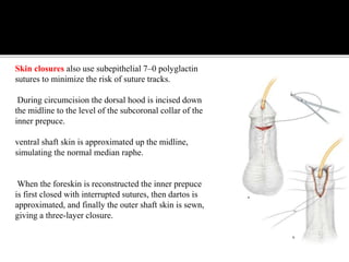 Subcoronal Incision Mid Penile Hypospadias | PPTX