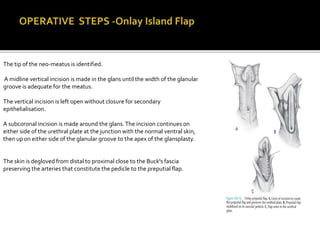 Subcoronal Incision Mid Penile Hypospadias | PPTX