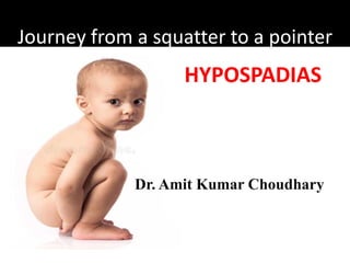 Journey from a squatter to a pointer
Dr. Amit Kumar Choudhary
HYPOSPADIAS
 