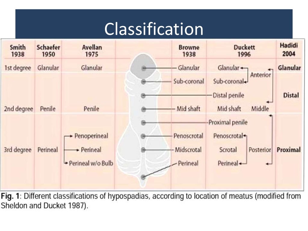 Hypospadias Hypospadias