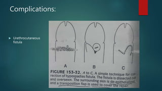 Hypospadias ppt