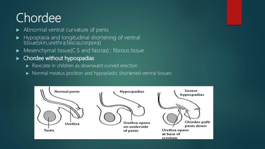 Hypospadias.ppt