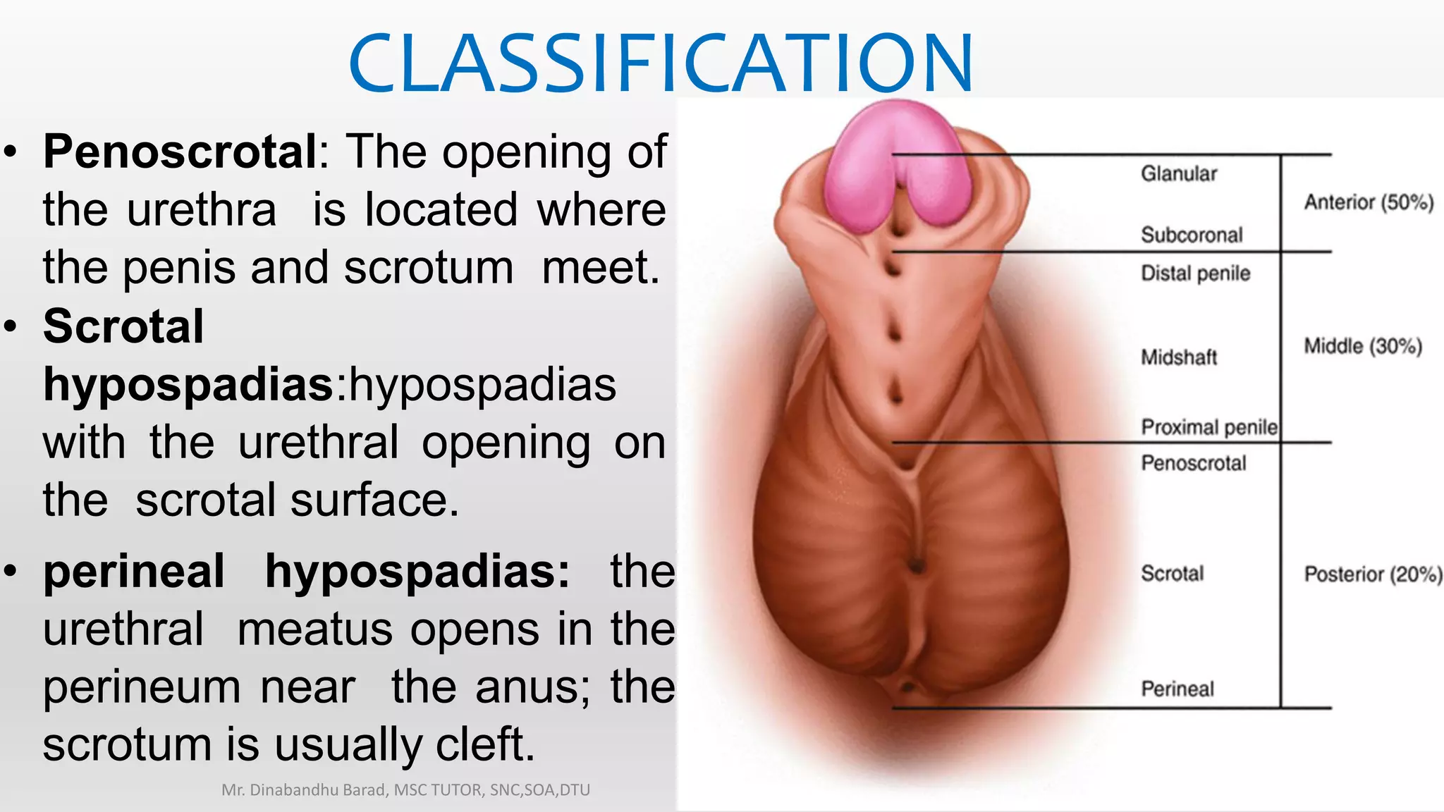 HYPOSPADIAS CONGENITAL ANOMALY OF GENITOURINARY SYSTEM PPTX HYPOSPADIAS CONGENITAL ANOMALY OF GENITOURINARY SYSTEM PPTX