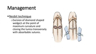 Management
Nesbit technique
oExcision of diamond shaped
wedge/s at the point of
maximum curvature and
closing the tunica transversely
with absorbable sutures.
 