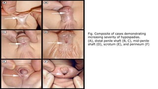 Fig. Composite of cases demonstrating
increasing severity of hypospadias.
(A), distal penile shaft (B, C), mid-penile
shaft (D), scrotum (E), and perineum (F)
 