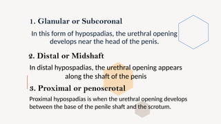 Subcoronal Incision HYPOSPADIAS Disease Brief Explanation Gender and Society 2nd year | PPTX