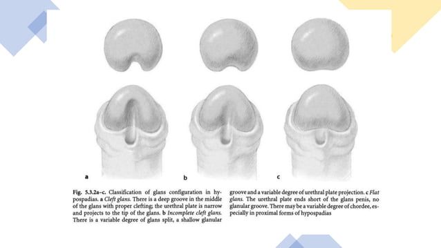 Hypospadias pptx Hypospadias pptx