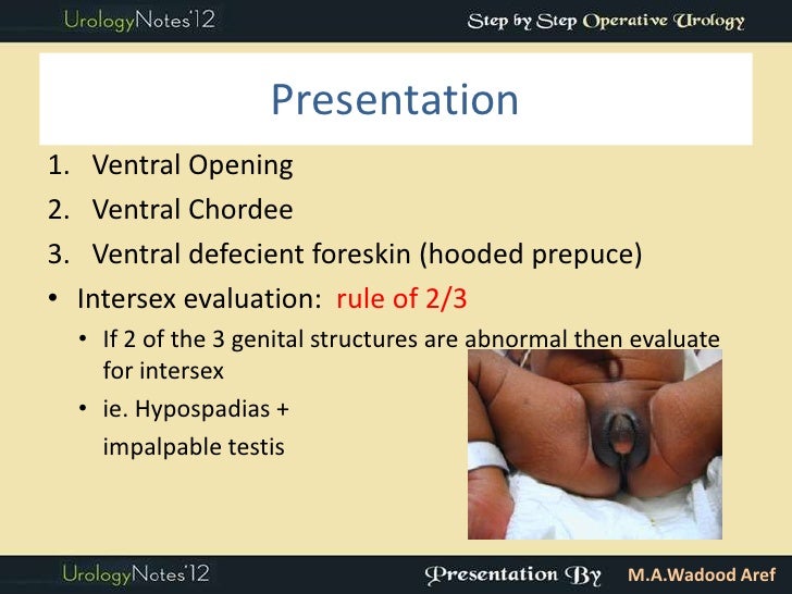 Hypospadias part 1 introd (step by step oper series)