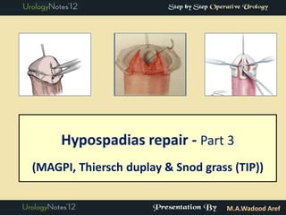 Hypospadias repair - Part 3
(MAGPI, Thiersch duplay & Snod grass (TIP))


                                    M.A.Wadood Aref
 