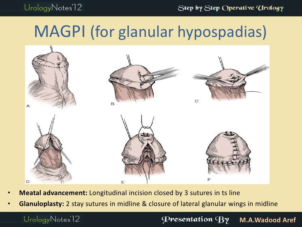 Hypospadias 3 MAGPI & snod grass (TIP) step by step operative urol…