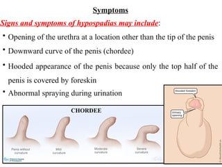 hypospadias AND epispadias .pptx