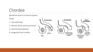 Chordee
Abnormal ventral curvature of penis
TYPES:
1 : skin tethering
2 : fibrotic dartos and bucks fascia
3: corporal disproportion
4: congenital short urethra
 
