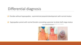Differential diagnosis
 Chordee without hyposapadias : asymmetrical preputial development with normal meatus
 Hypospadias variant with normal foreskin concealing a granular to distal shaft mega meatus
 