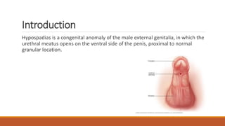 Introduction
Hypospadias is a congenital anomaly of the male external genitalia, in which the
urethral meatus opens on the ventral side of the penis, proximal to normal
granular location.
 