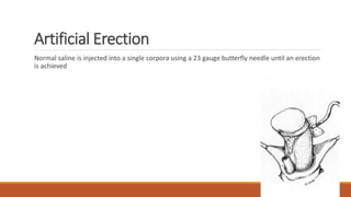 Artificial Erection
Normal saline is injected into a single corpora using a 23 gauge butterfly needle until an erection
is achieved
 