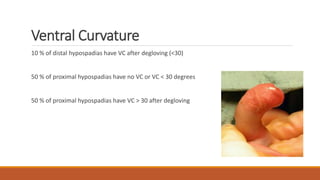 Ventral Curvature
10 % of distal hypospadias have VC after degloving (<30)
50 % of proximal hypospadias have no VC or VC < 30 degrees
50 % of proximal hypospadias have VC > 30 after degloving
 