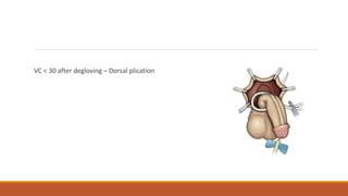 VC < 30 after degloving – Dorsal plication
 