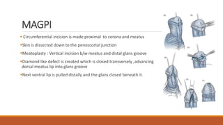 MAGPI
 Circumferential incision is made proximal to corona and meatus
Skin is dissected down to the penoscortal junction
Meatoplasty : Vertical incision b/w meatus and distal glans groove
Diamond like defect is created which is closed transversely ,advancing
dorsal meatus lip into glans groove
Next ventral lip is pulled distally and the glans closed beneath it.
 