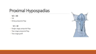 Proximal Hypospadias
VC < 30
◦ TIP
◦ Onlay preputial flap
VC > 30
◦ Single stage preputial flap
◦ Two stage preputial flap
◦ Two stage graft
 