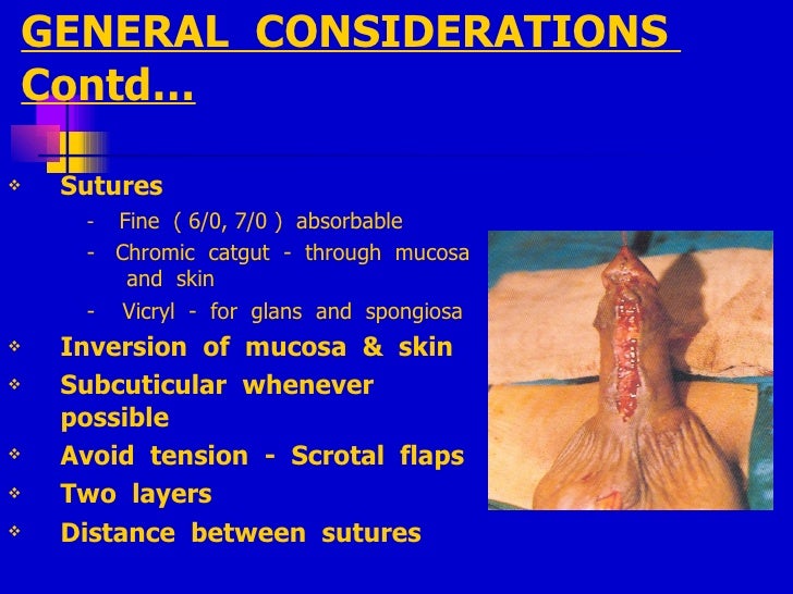 Hypospadias Surgery ,How To Avoid Complications