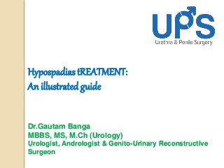 Hypospadias tREATMENT:
An illustrated guide
Dr.Gautam Banga
MBBS, MS, M.Ch (Urology)
Urologist, Andrologist & Genito-Urinary Reconstructive
Surgeon
 