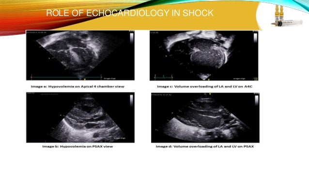 narrow pulse pressure