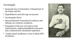 Acromegaly
• Increased size of extremities: Enlargement of
the hands and feet
• Hyperhidrosis and skin tags are present
• Acromegalic facies
• Musculoskeletal: Generalized weakness and
lethargy are common symptoms.
• Elongation of the jaw can lead to teeth
malocclusion, temporomandibular joint pain,
and a characteristic interdental separation.
• Carpal tunnel syndrome is seen in about 60%
of patients.
 