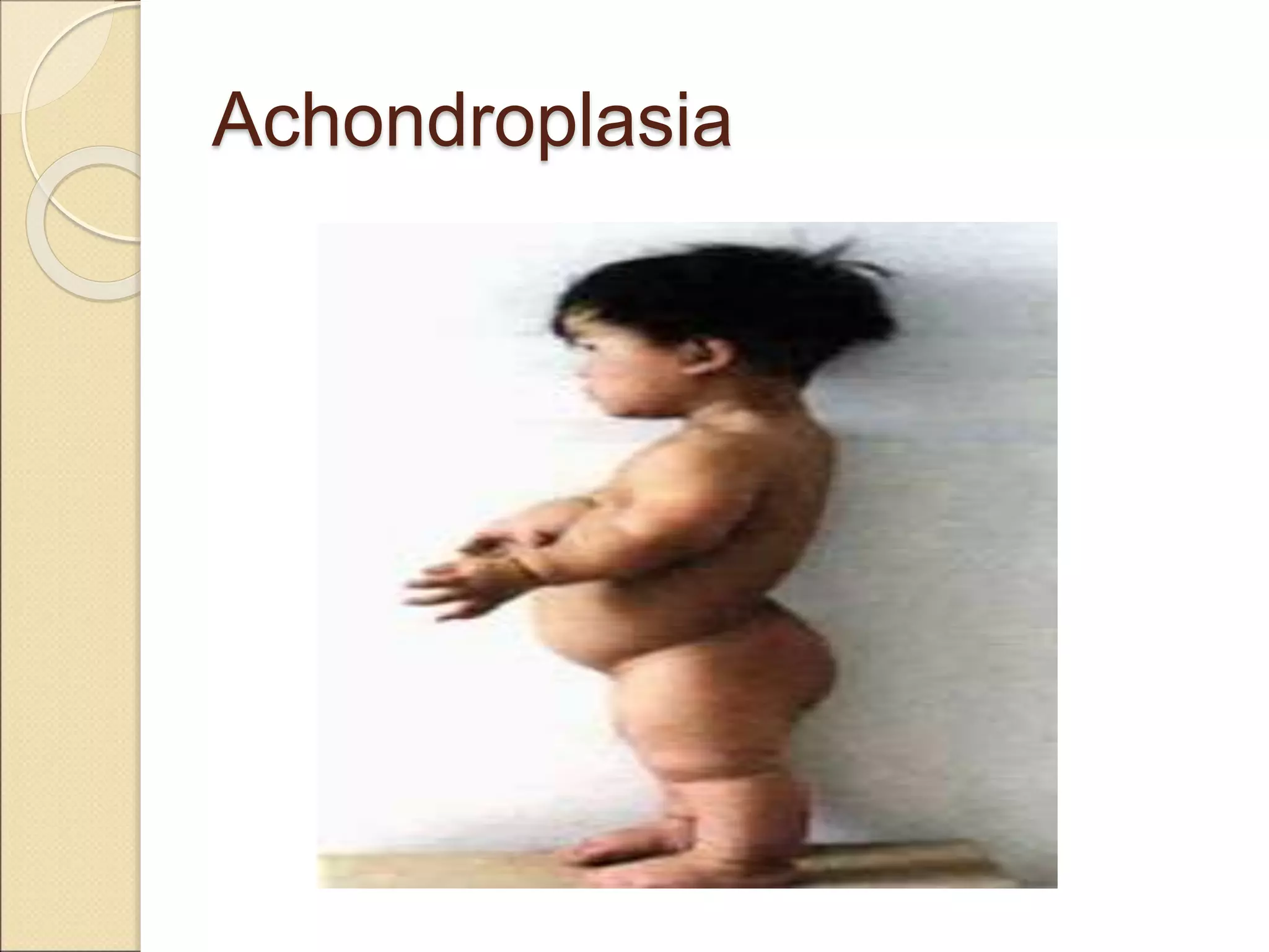 Achondroplasia
 
