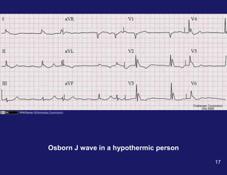 Osborn J wave in a hypothermic person
WikiSysop (Wikimedia Commons)
17
 