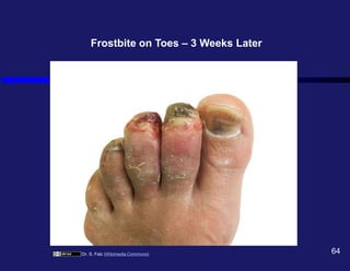 Dr. S. Falz (Wikimedia Commons) 64
Frostbite on Toes – 3 Weeks Later
 