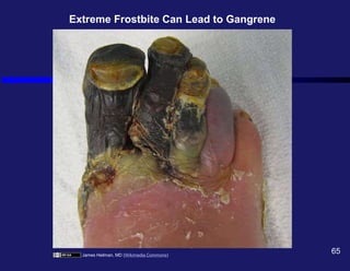 James Heilman, MD (Wikimedia Commons)
65
Extreme Frostbite Can Lead to Gangrene
 