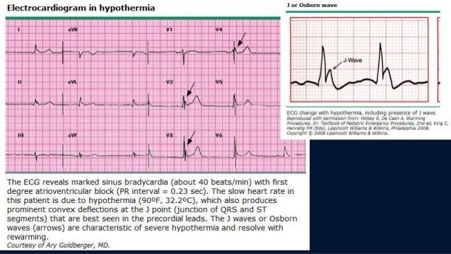 hypothermia hypothermia temperature time chart