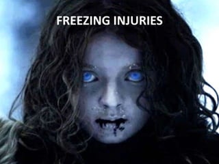 FREEZING INJURIES
 