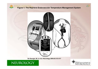 Figure 1. The Reprieve Endovascular Temperature Management System




          De Georgia, M. A. et al. Neurology 2004;63:312-317
 