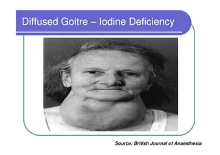 Diffused Goitre – Iodine Deficiency




                     Source: British Journal of Anaesthesia
 