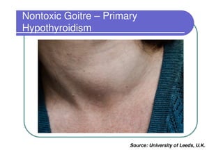 Nontoxic Goitre – Primary
Hypothyroidism




                       Source: University of Leeds, U.K.
 