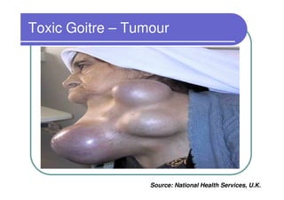 Toxic Goitre – Tumour




                  Source: National Health Services, U.K.
 