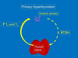 Hypothyroid | PPTX